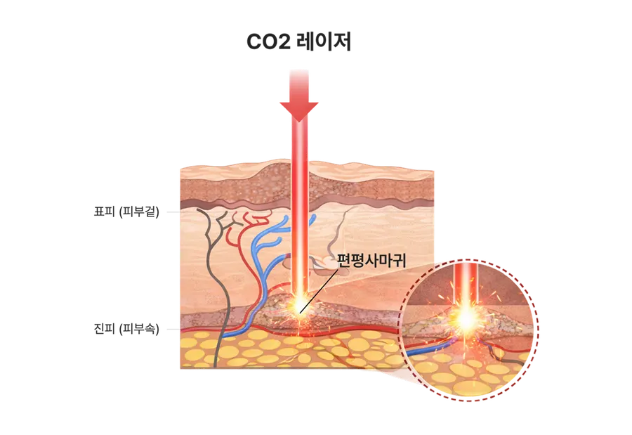 편평사마귀 레이저 비교 이미지