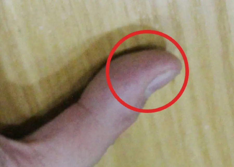 wart after1 — 구리올바디한의원