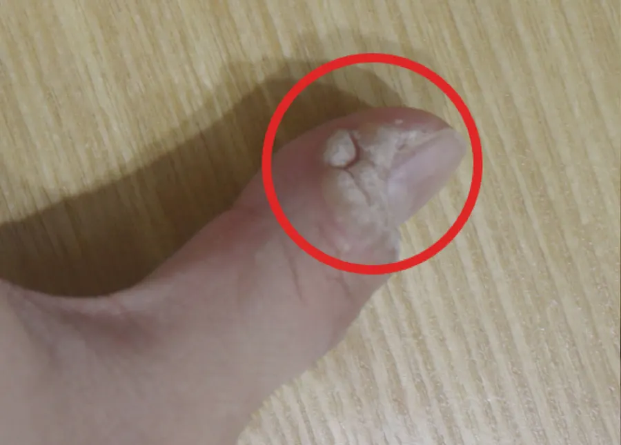 wart before1 — 구리올바디한의원