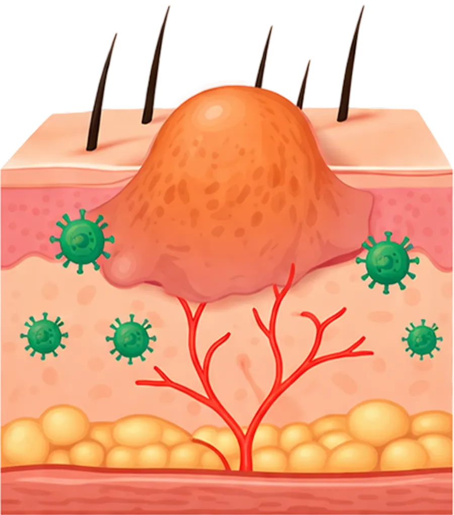 wart virus3 — 구리올바디한의원